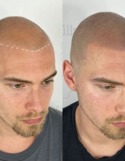 Micropigmentación Capilar antes y después